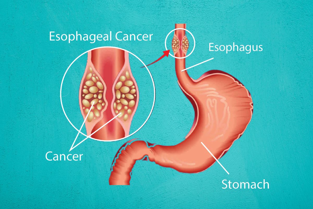 Oesophageal Cancer