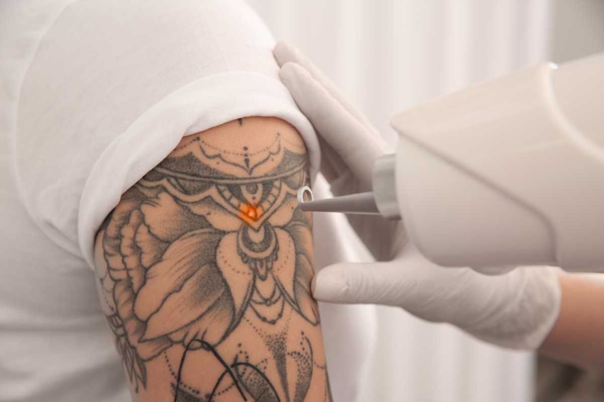 Tattoo Removal (2)