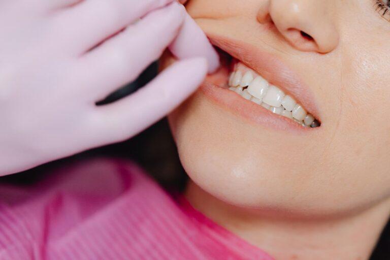 Adult Teeth Shift After Childhood