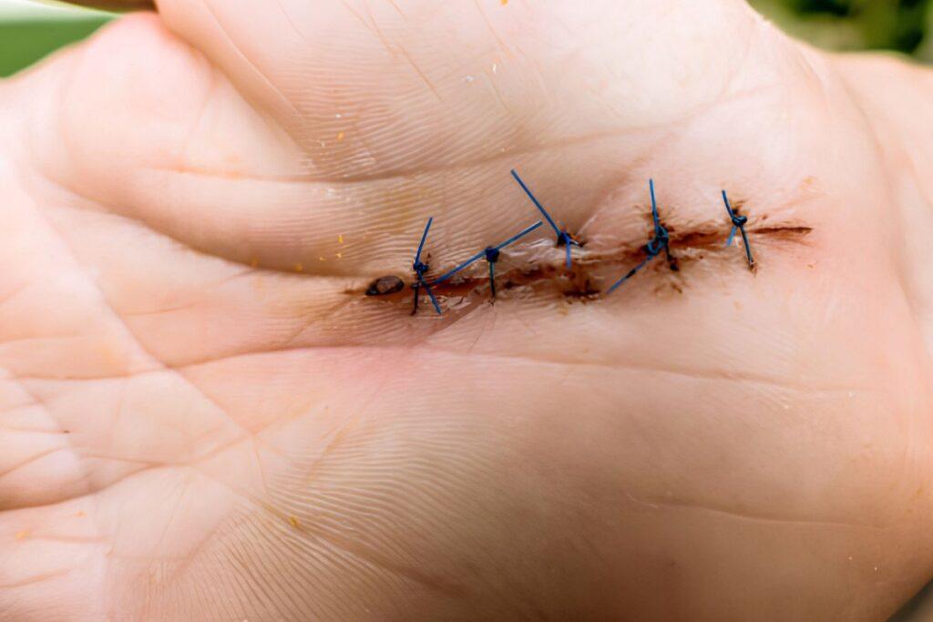 Dissolvable Stitches