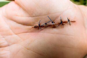 Dissolvable Stitches