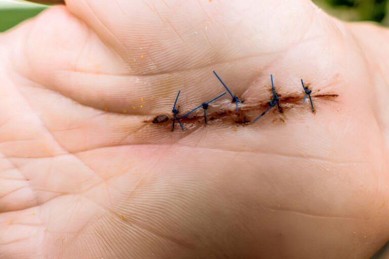 Dissolvable Stitches