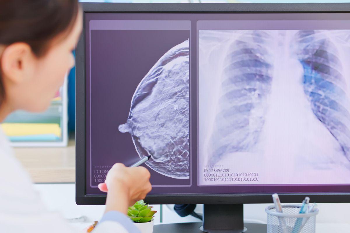 breast cancer Screening
